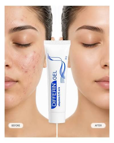 ژل ضد جوش دیفرین آداپالن اصل فرانسه